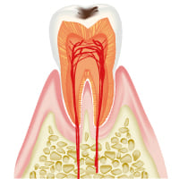 C1軽度のむし歯