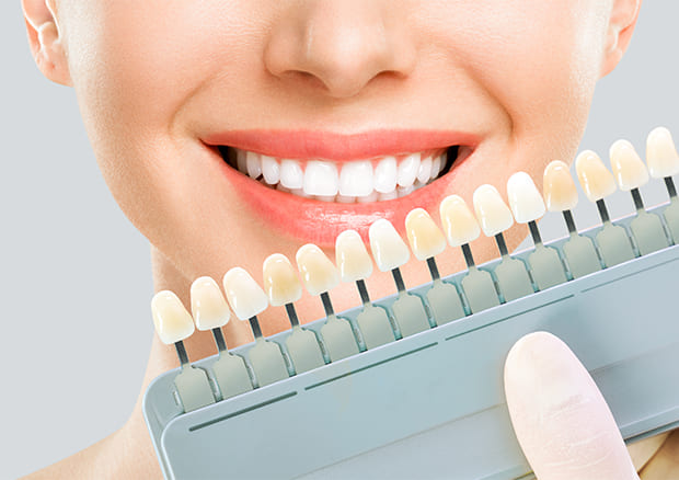 短期間で白い歯になるダイレクトボンディング