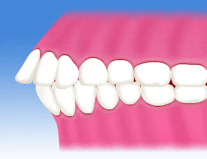 上顎前突の場合