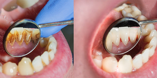 プロによるクリーニング PMTC